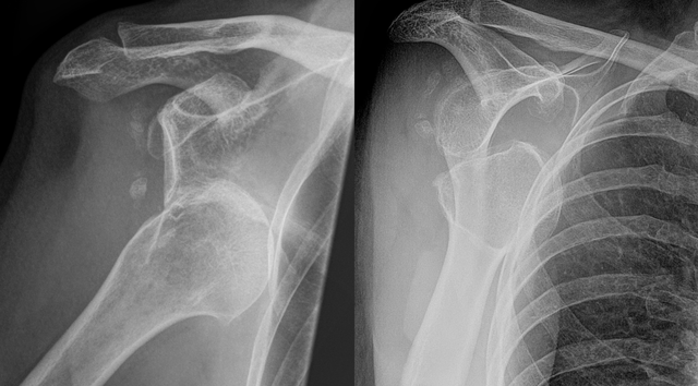 X-ray of dislocated shoulder