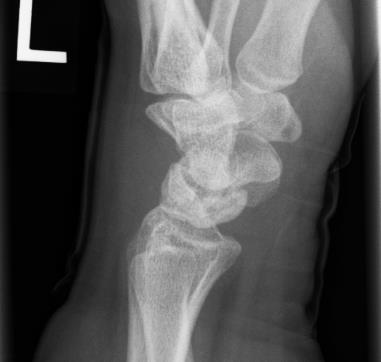 Left hand x-ray with Kienbock's disease. Kienbock's disease surgery may be required.