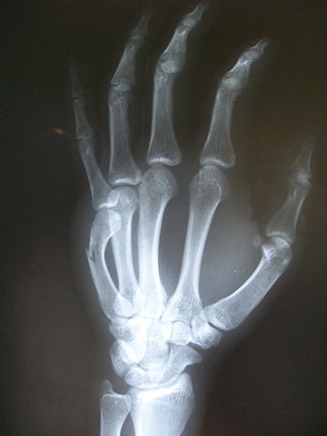 Xray of a boxer's fracture